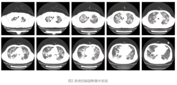 Diffuse large B-cell lymphoma (DLBCL), non-germinal center subtype, involving the nasal cavity and sinuses-02