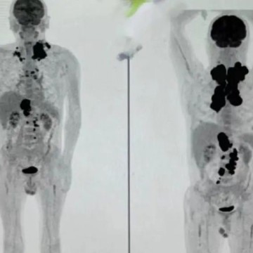 Mrs. Siti ---- Diffuse Large B-cell Lymphoma (DLBCL)