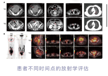 Endometrial cancer stage IVB-04