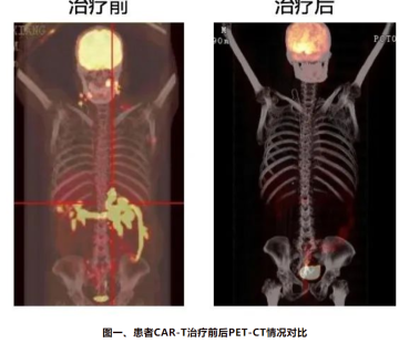 Diffuse large B-cell lymphoma(DLBCL)-03