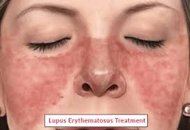 CAR-T for Systemic Lupus Erythematosus (SLE)