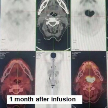 Diffuse Large B-cell Lymphoma (DLBCL)