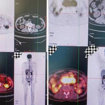 Multi-line Resistant Diffuse Large B-cell Lymphoma (DLBCL)