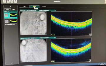 Optic Nerve Injury-01