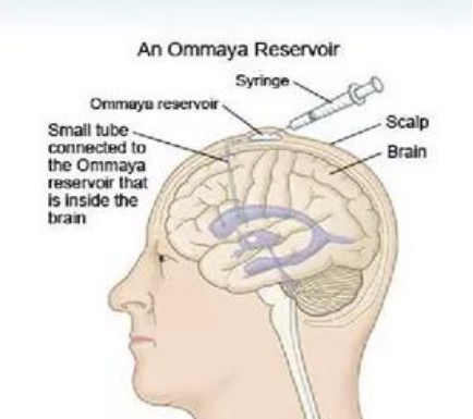 ommaya囊.png