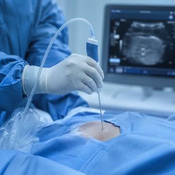 Cryosurgical Ablation (CSA) — Precision Cold Therapy for Solid Tumors