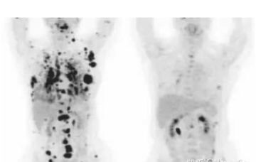 Left breast cancer accompanied by multiple bone metastases (Stage IV), lymph node metastasis, and carcinomatous lymphangitis in both lungs-03
