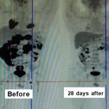 Mr. C----Diffuse Large B-cell Lymphoma (DLBCL)